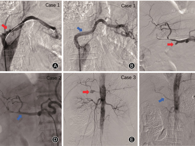 Stent-graft implantation for late postpancreatectomy hemorrhage after pancreatoduodenectomy