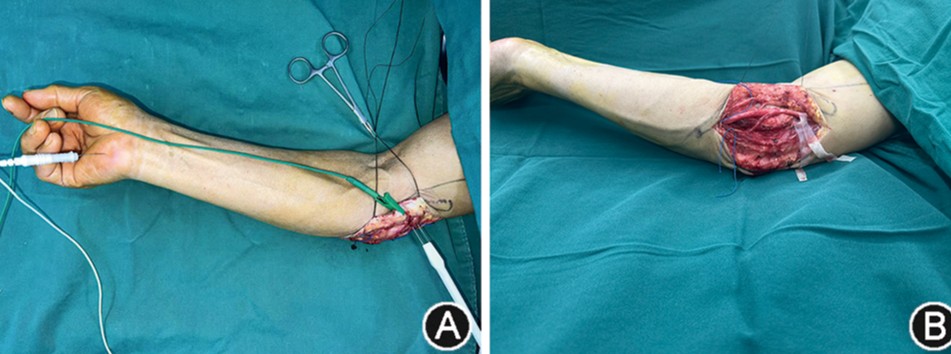 Analysis on the effect of subfascial anterior transposition of the ulnar nerve with vascularized fascial flap combined with intraoperative neurophysiological monitoring in the treatment of moderate to severe cubital tunnel syndrome