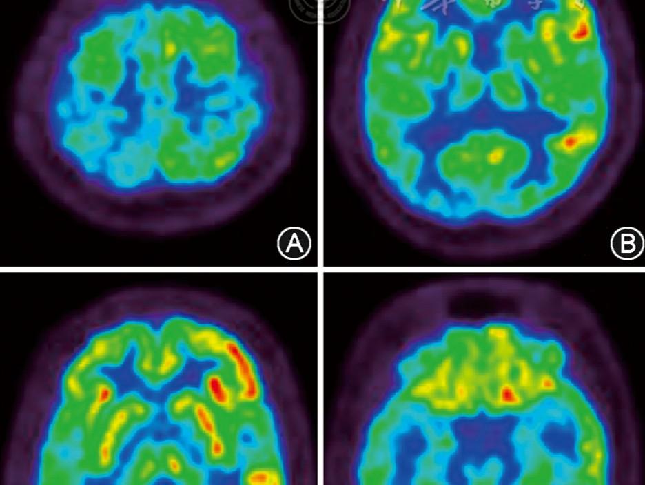 Anti-N-methyl-D-aspartate receptor encephalitis presenting with a hippocampal-caudate involvement pattern: a case report