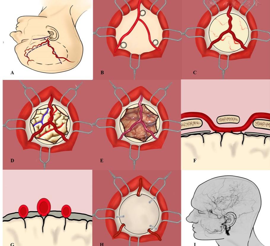 A novel superficial temporal artery patency concept of cerebral revascularization for patients with moyamoya disease: a multicenter study
