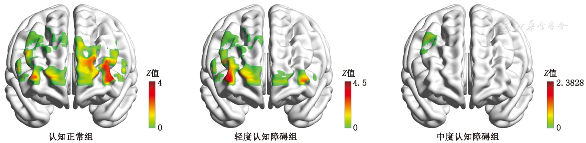 帕金森病患者认知功能障碍的脑区激活机制：一项基于近红外脑功能成像的研究