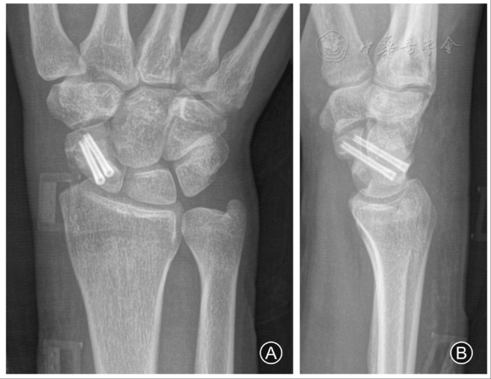 Treatment of scaphoid nonunion with dual screw fixation in preventing postoperative humpback deformity