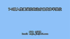 植入性囊袋拉钩治疗晶状体半脱位