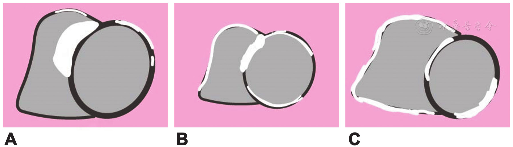 Comparative Evaluation of Cardiac Sarcoidosis, Giant Cell Myocarditis, and Arrhythmogenic Right Ventricular Cardiomyopathy on Cardiac Magnetic Resonance